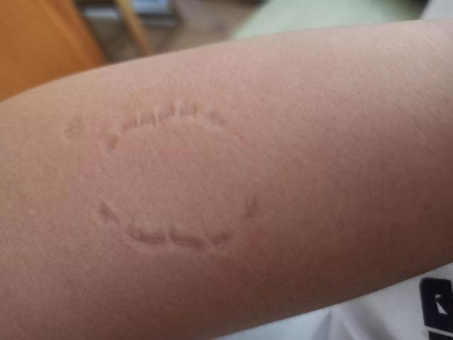 今天在家闲来没事儿,和妈妈玩闹,给妈妈胳膊上咬了一排牙印留做纪念