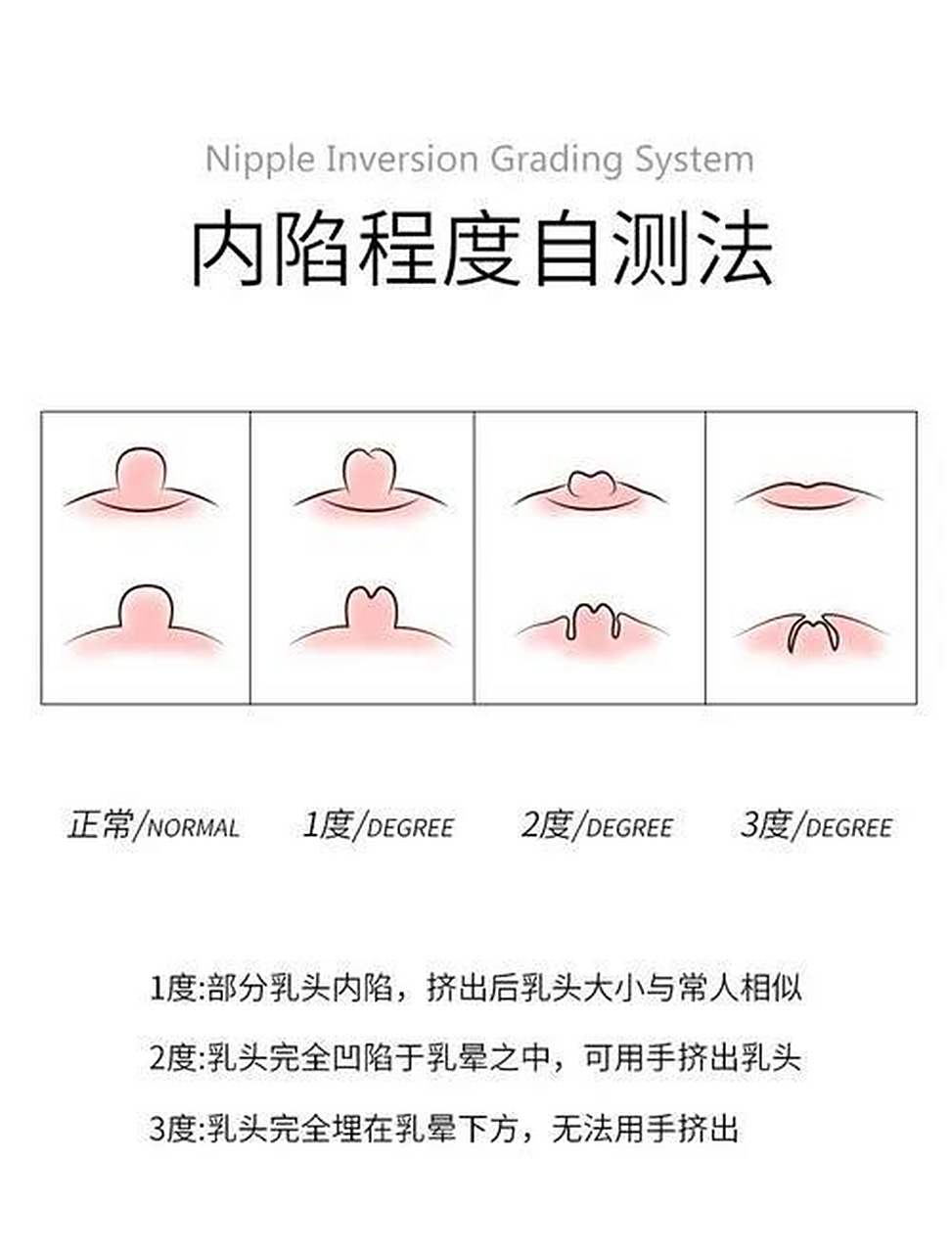 内陷是一种常见的乳房问题,患者的乳头向内缩进,出现隆起或凹陷的现象