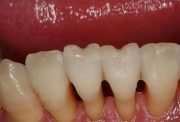 牙齿"松动",到底是拔还是不拔?