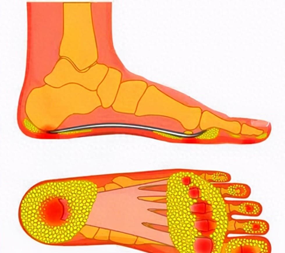 中老年人脚底板疼,常有4种病因,医生告诉您如何鉴别!并非骨刺