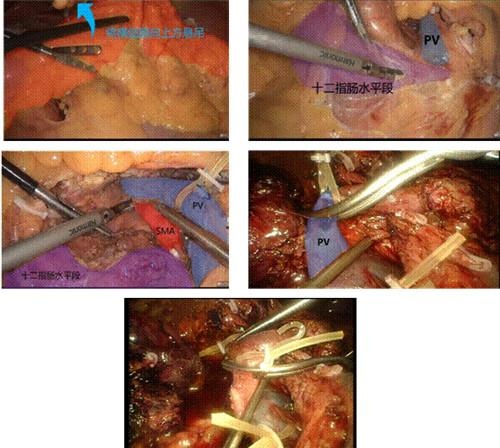 刘续宝教授及柯能文副教授团队完成国际首例腹腔镜经结肠下区原位胰