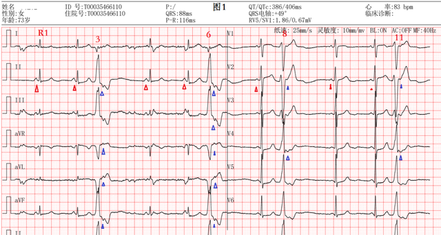室性早搏心电图特点图片