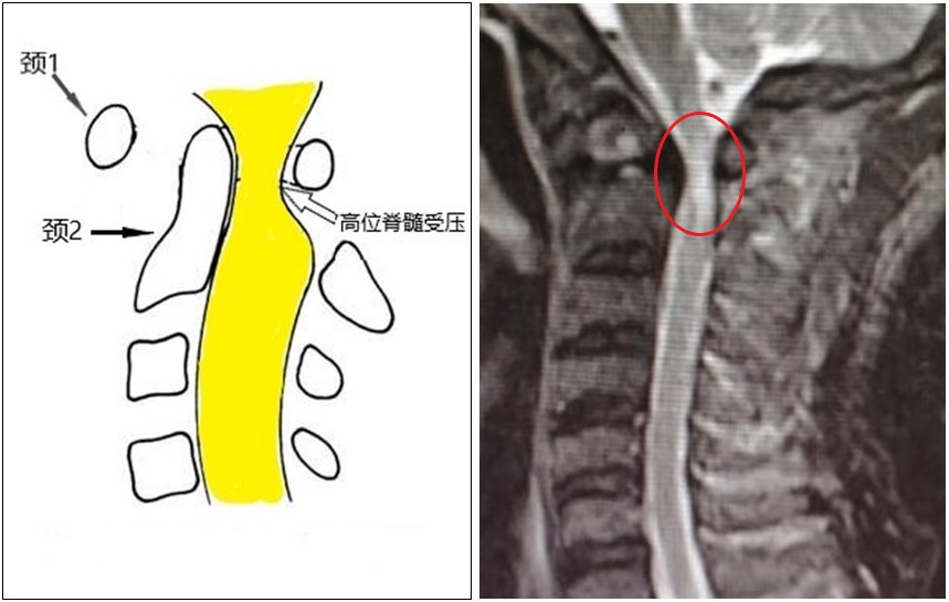 寰枢关节间隙左窄右宽图片