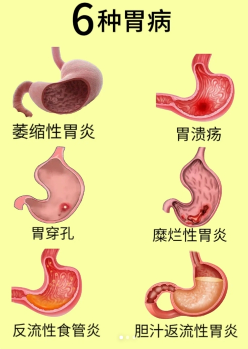 张正凡:6种胃病!你有这些症状吗?