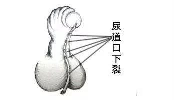 尿道下裂常见症状有哪些?你了解多少?