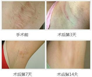 女性腋臭什麼年齡消失(輕微狐臭能自愈嗎)