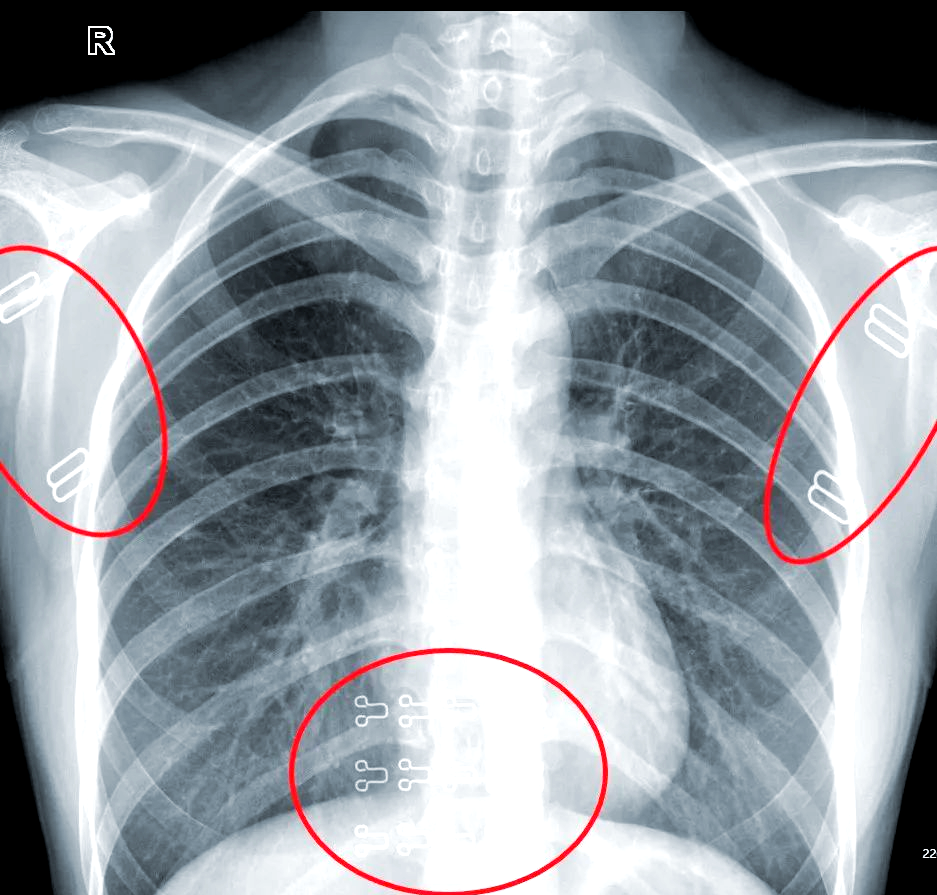 通过对比正常胸部正位片与未脱内衣的胸部正位片,我们可以清晰地看到