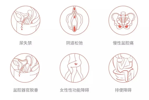 产后缩阴手术真的有用,根据松弛程度选择合适的手术是关键