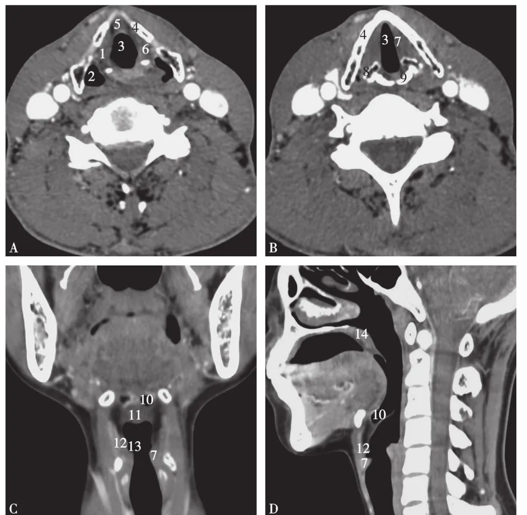 —从ct影像看喉部病变,值得收藏!