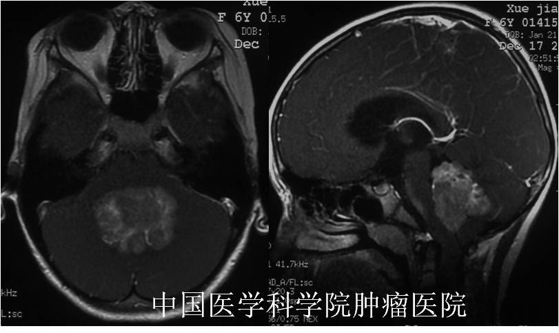 开颅手术切除颅内髓母细胞瘤