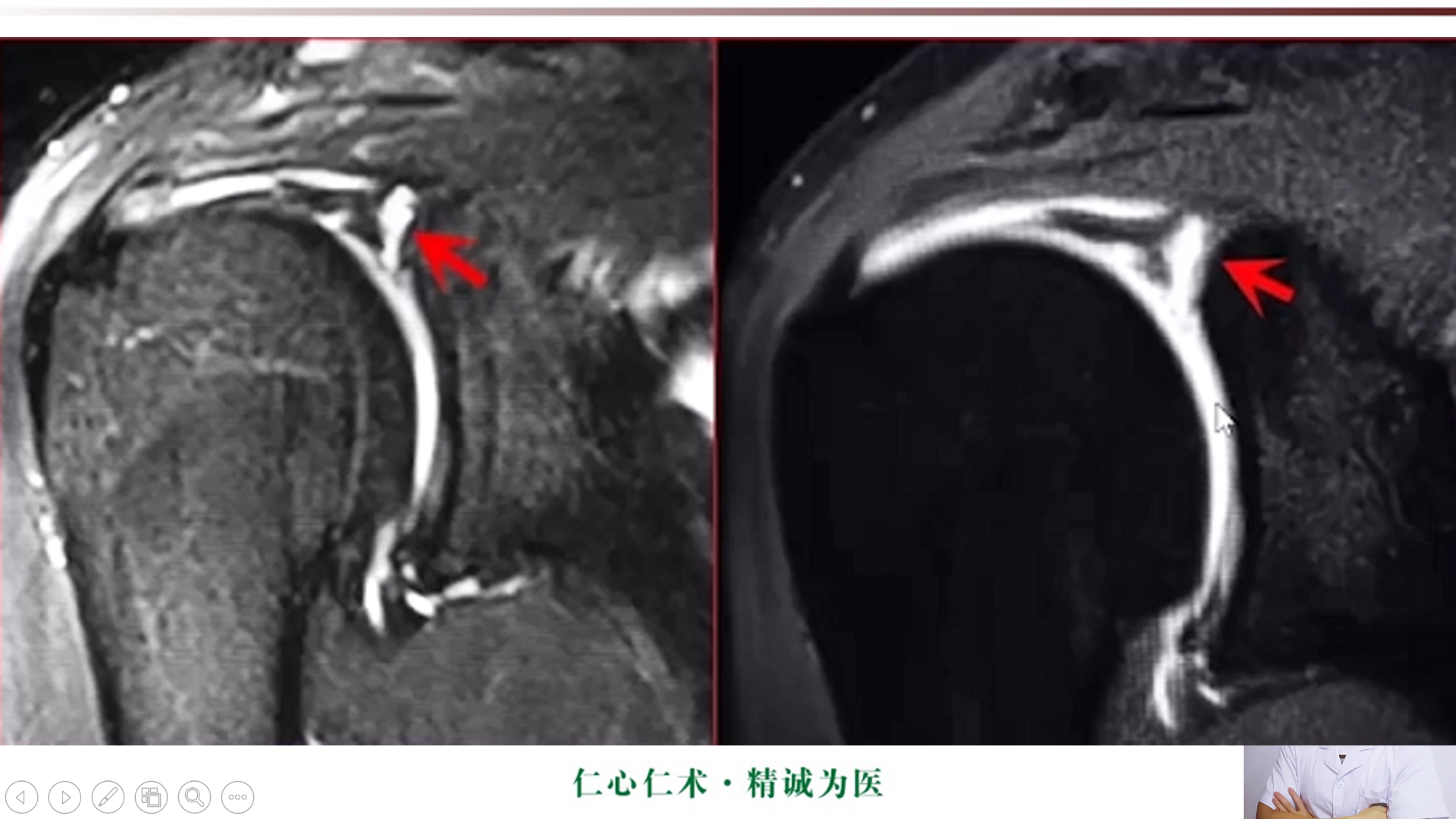 肩关节mri精品课程 肩关节盂唇损伤mri表现