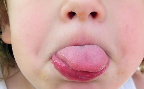 舌头是健康"晴雨表,经常看孩子的舌头,哪不舒服家长一目了然