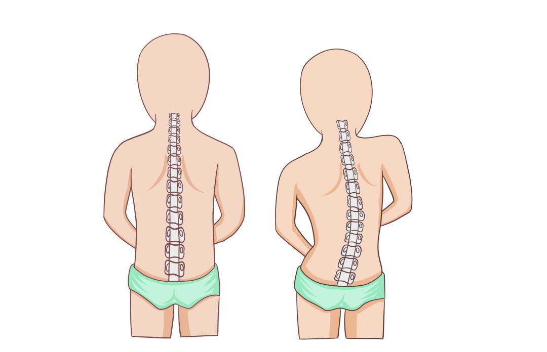 如何避免脊柱侧弯反弹?