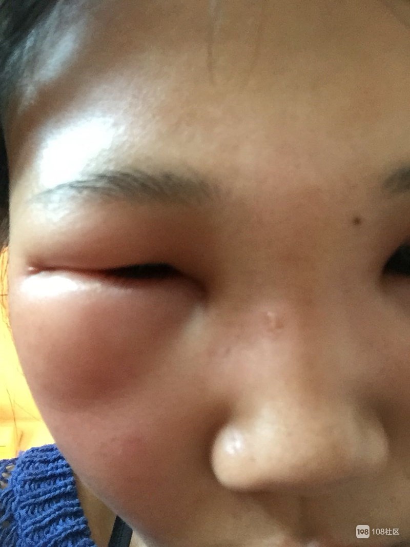 早上起来眼睛肿了怎么办?医生推荐3个方法快速消除肿眼泡