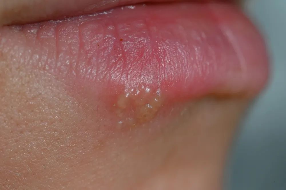 周皮肤上一块指甲大小的区域发红,痒丝丝,皱巴巴的,不舒服;长单纯疱疹
