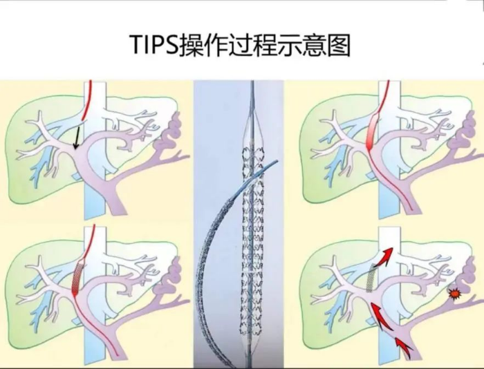 介入手术示意图图片