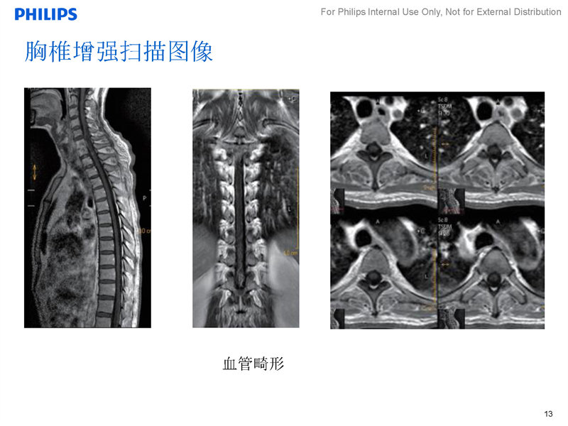 胸椎扫描方案|磁共振规范化扫描方案|飞利浦