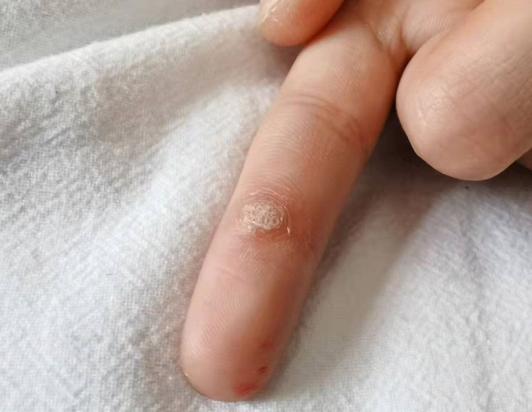 千万别大意!这些地方长"小疙瘩",可能诱发癌变