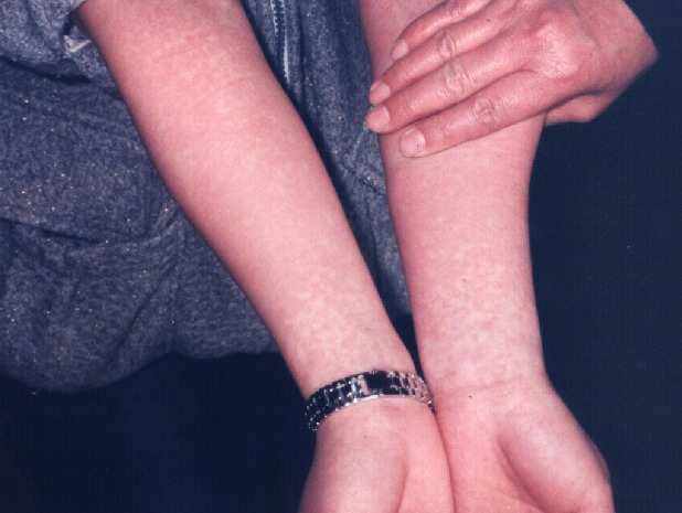 猩红热:"烂喉痧"