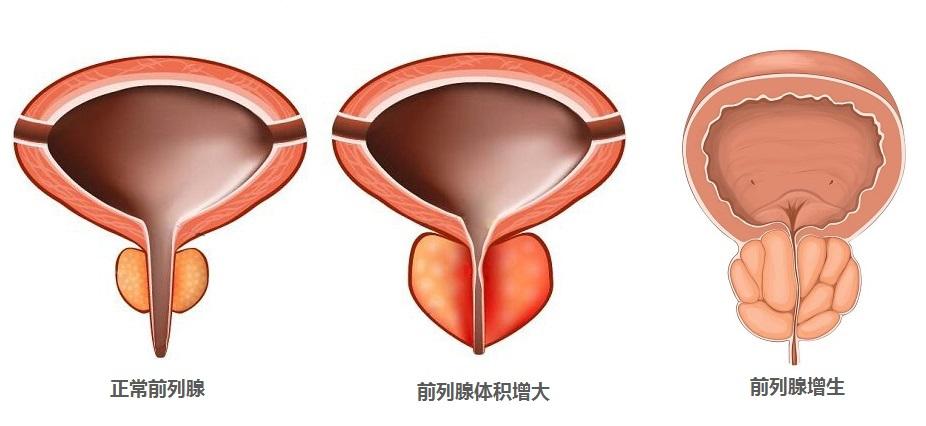 前列腺肥大怎麼造成的?