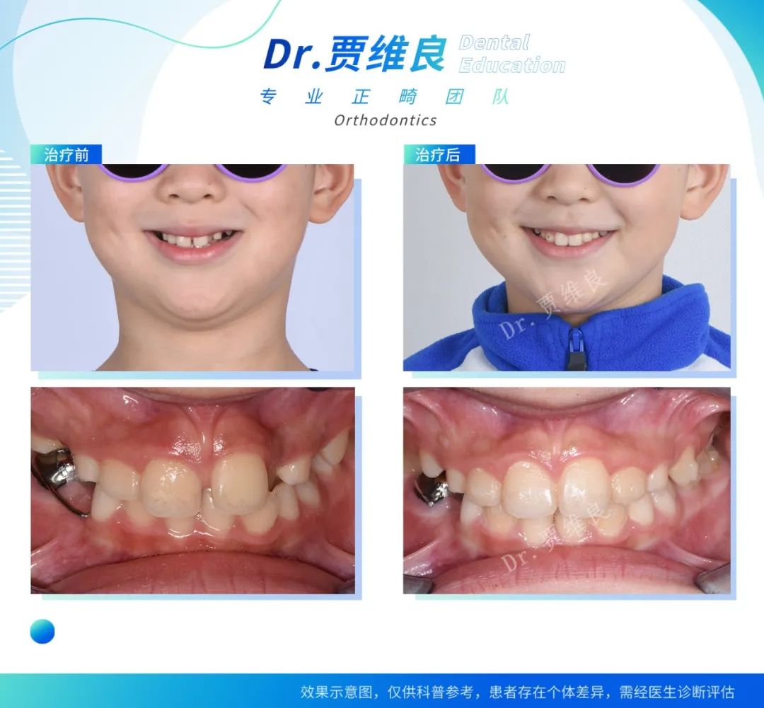 新合生口腔时代天使儿童版牙套适合哪些孩子戴