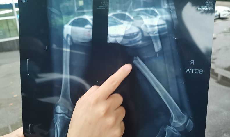 急急急!男子腰椎粉碎性骨折,急需这种血型血小板救命!
