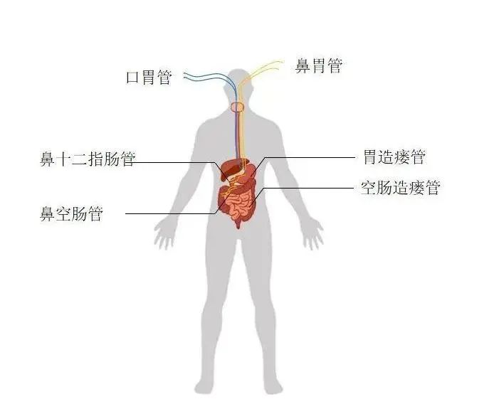 传闻中的肠内营养