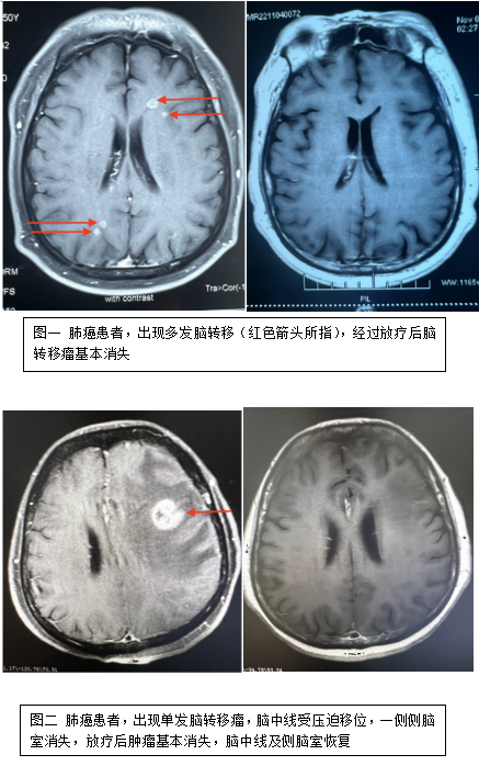 "脑转移"不可怕,规范诊疗是关键