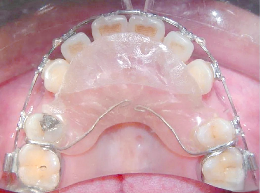 正畸活动矫治器相关的多种图谱与信息