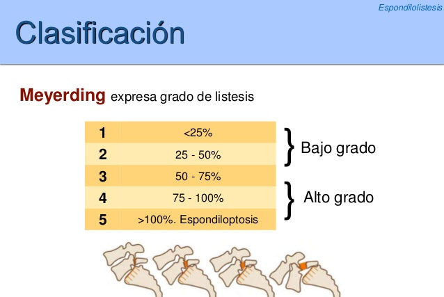 腰椎滑脱程度的分级图解