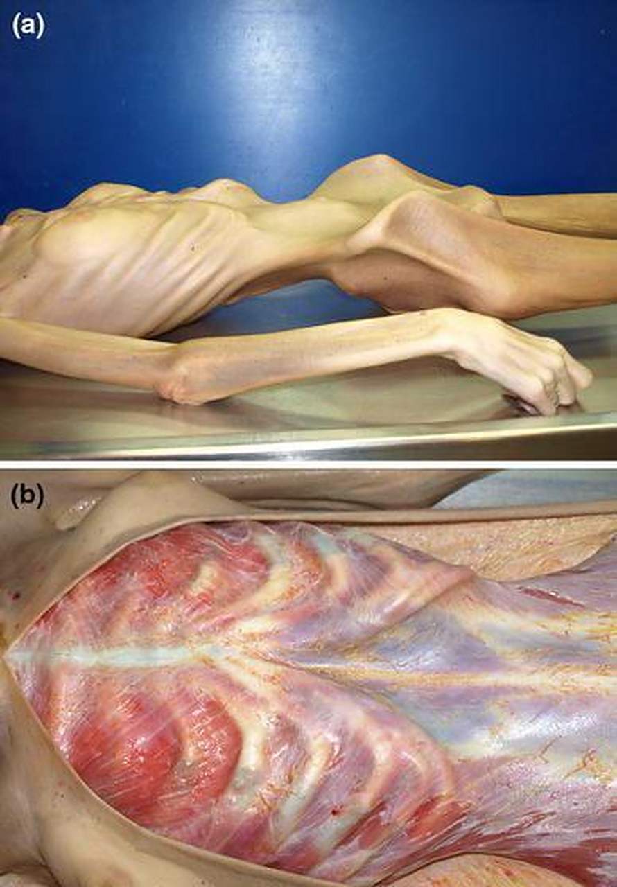 神经性厌食症导致她死于营养不良.患者身高 1.65米,体重 57斤.