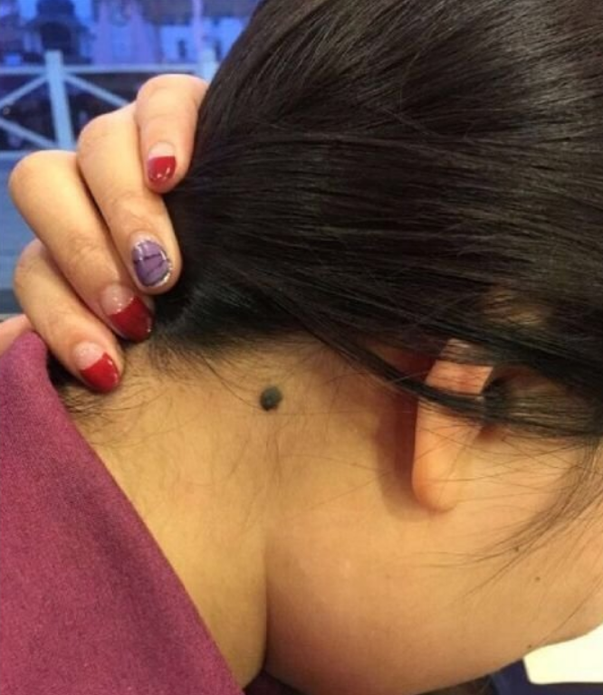 再三提醒:若黑痣长在这3个部位,建议大家要引起高度警惕