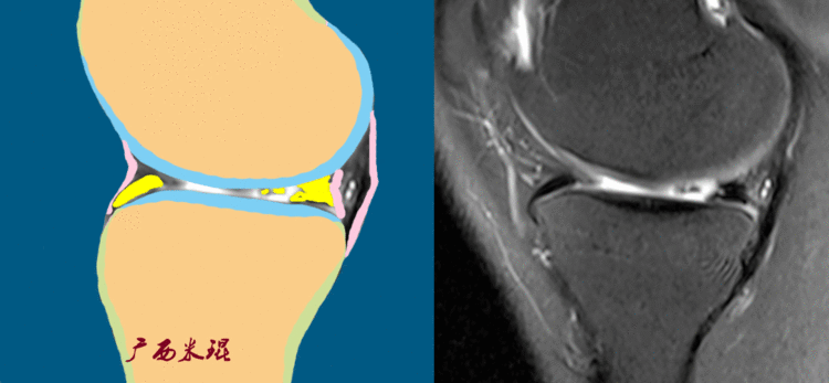 半月板损伤的mri诊断基础