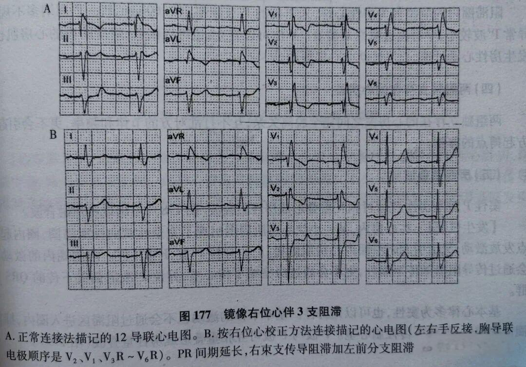 右位心的定义,心电图特征及诊断解析