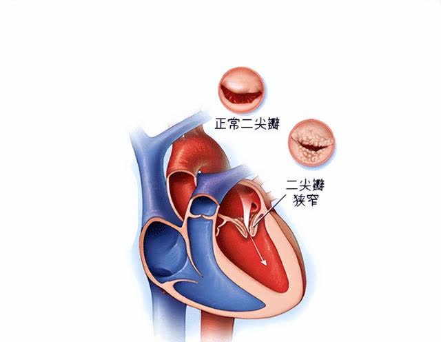 二尖瓣区位置图图片