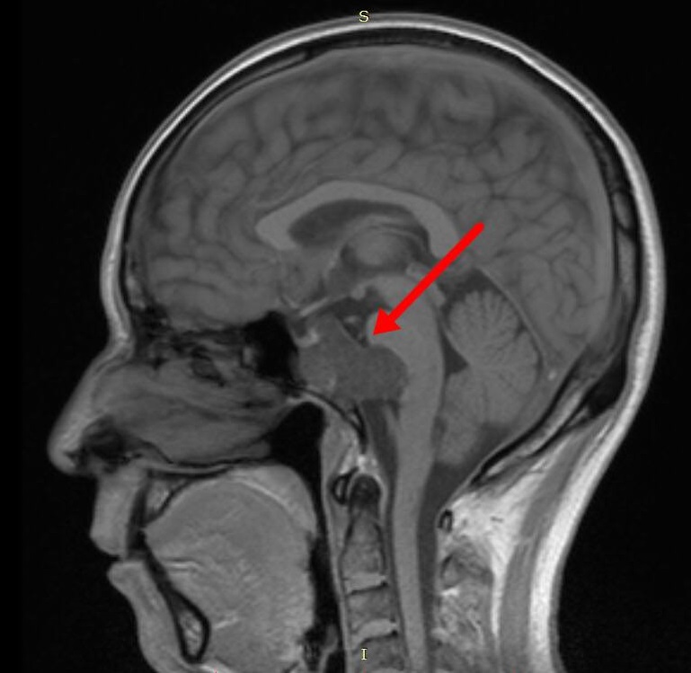 颅底脊索瘤(五):影像特点