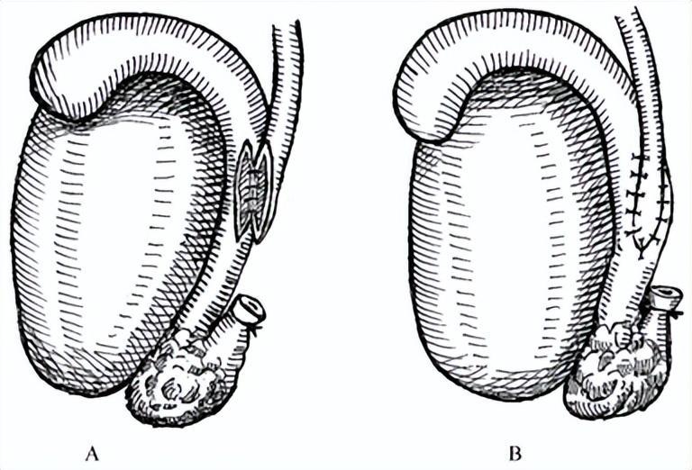 江西省妇幼保健院成功开展显微镜下附睾输精管吻合术