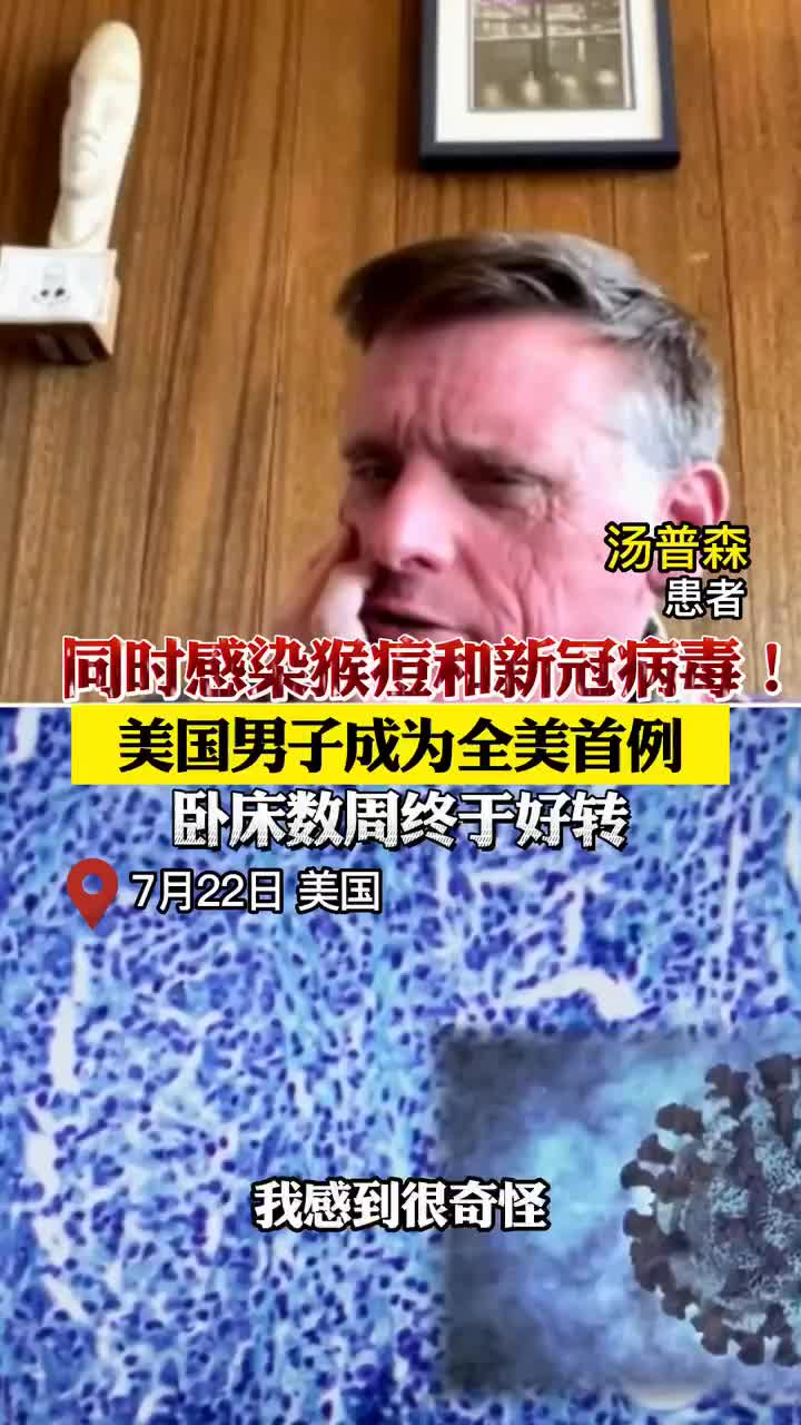 同时感染猴痘和新冠美国男子卧床数周终于好转