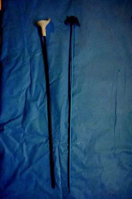 输尿管软镜终于有了用武之地!这主要是因为有了通路鞘 (uas)!