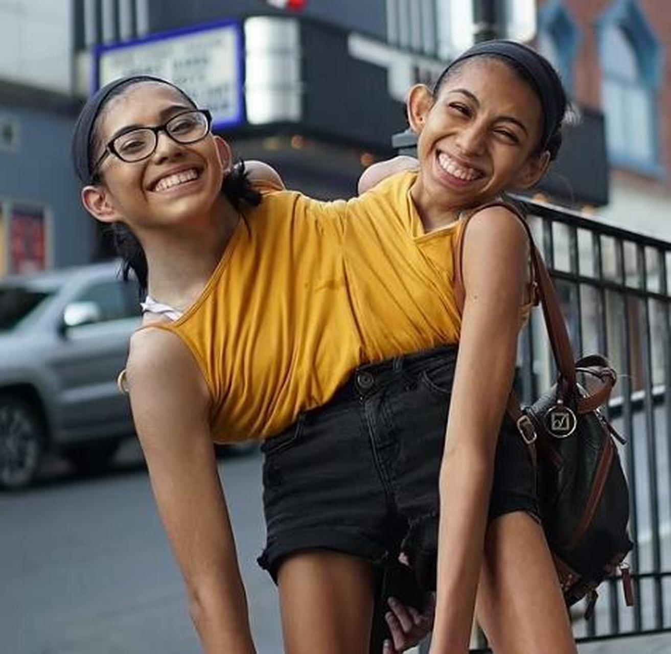 墨西哥一对连体双胞胎共享身体长达22年,姐姐交了男友后,碍于生理因素