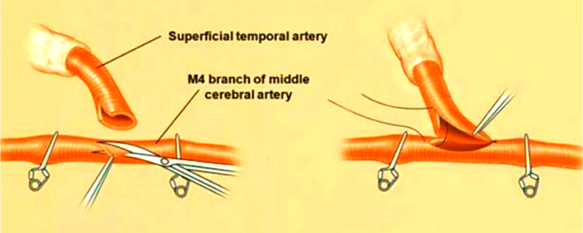 下肢动脉搭桥术:安全有效的"保腿"方法
