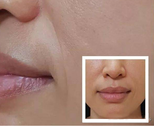 法令纹是鼻翼两侧延伸而下的两道纹路,年纪越大法令纹越深,看起来很显