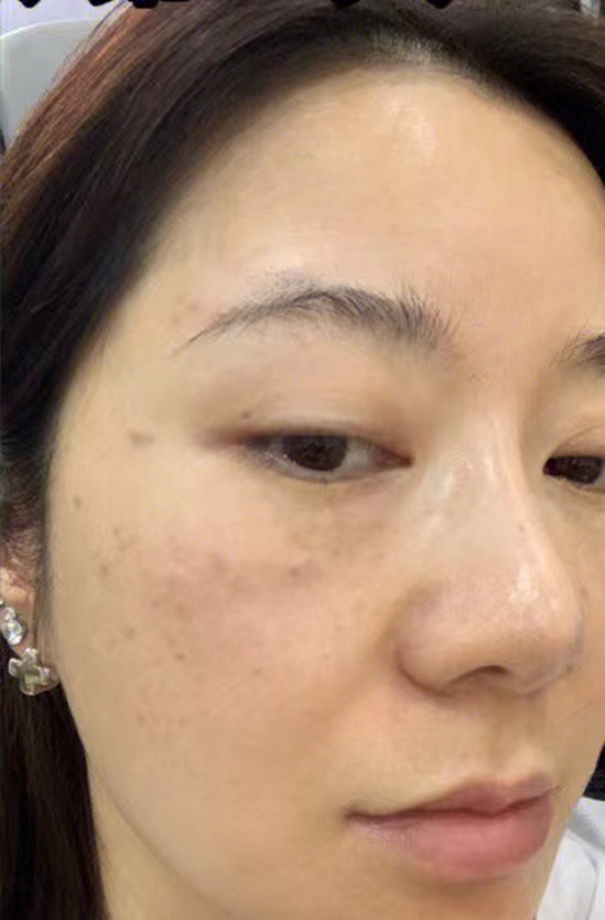 神奇的祛斑原液,有斑人的福音