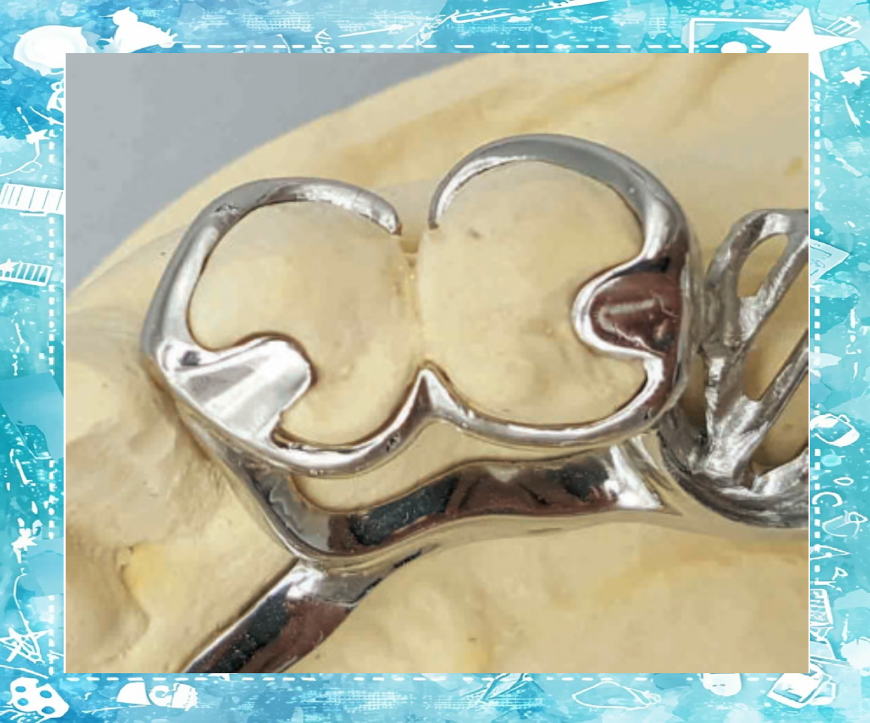 联合卡环,一种创新的固位设计,通过共同卡环体将位