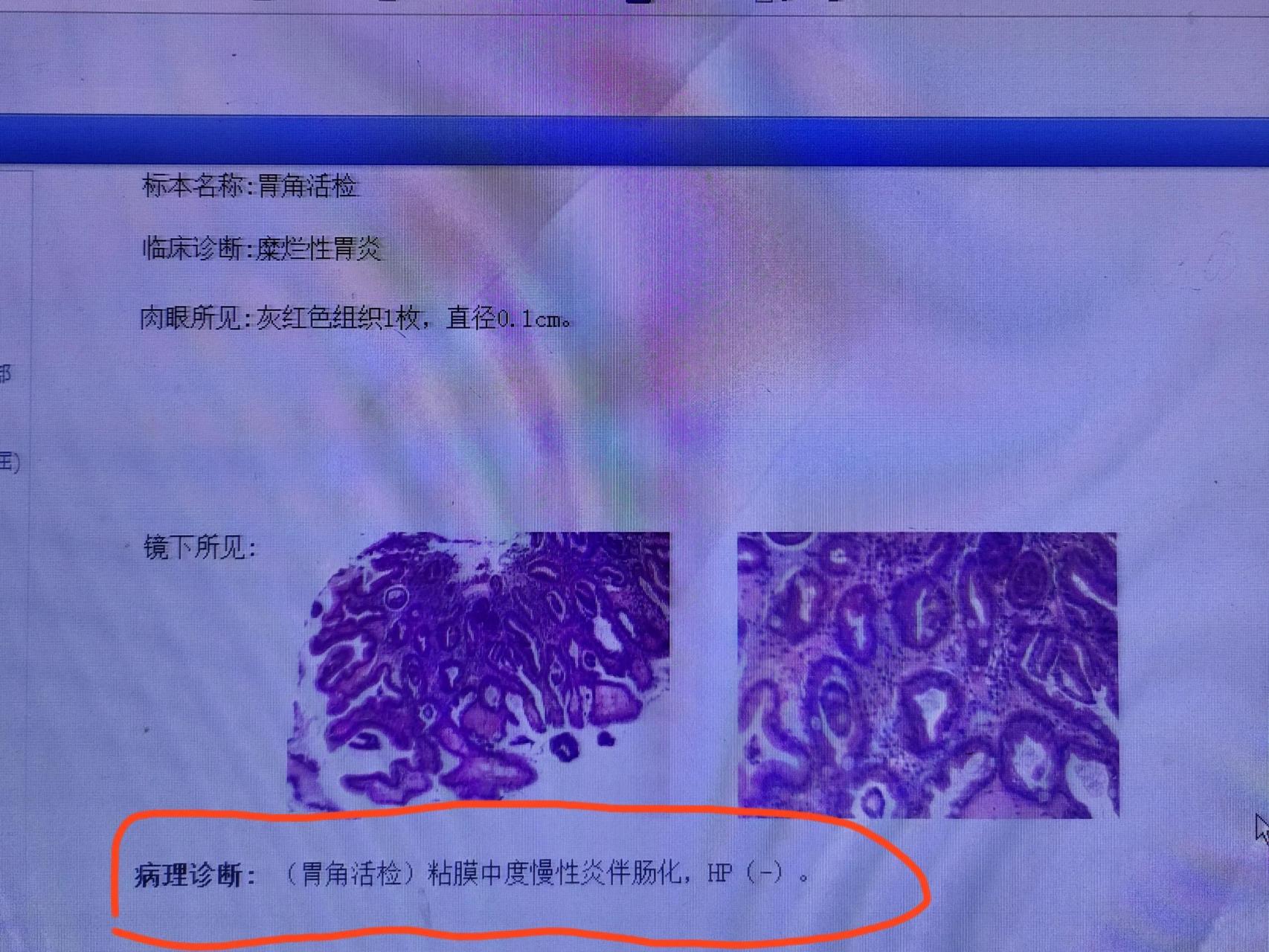 咨询请教各位网友: 这是我胃镜检查报告和病理诊断结果,一年前c14吹气