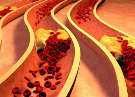 血管外科刁永鵬:怎樣正確降血脂?這3點幫助大家