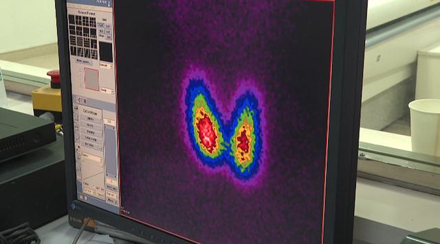 碘131治疗,会不会影响身体其他器官?