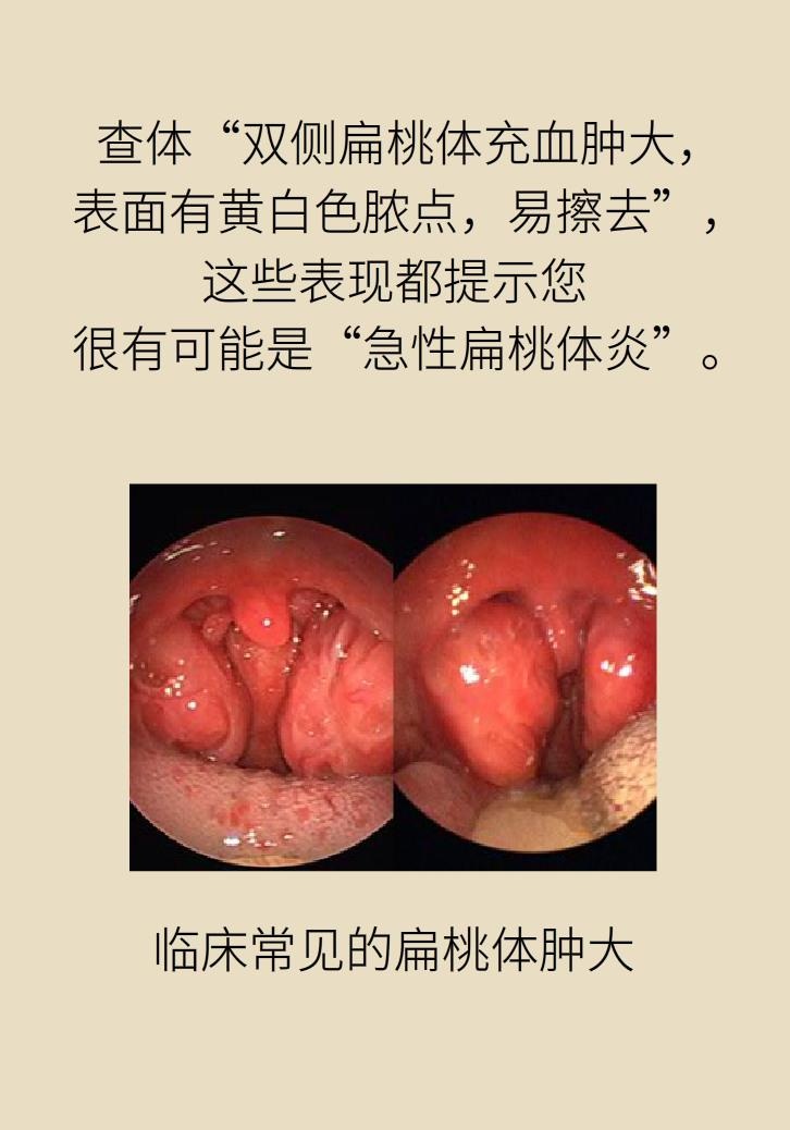 单侧扁桃体肿大更凶险!谨防恶性肿瘤