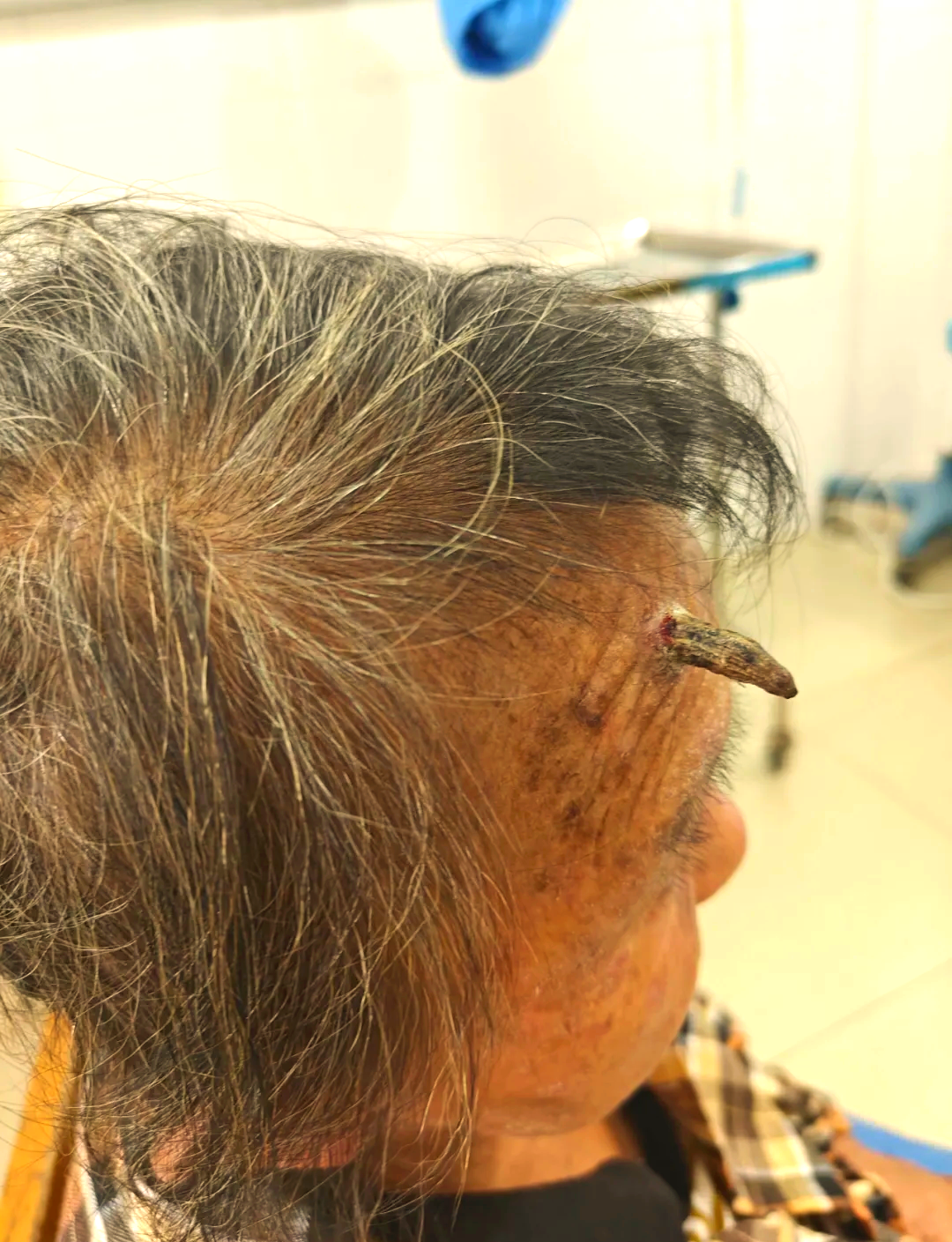 老人剪除"头上长角"引发手术,皮角现象需警惕