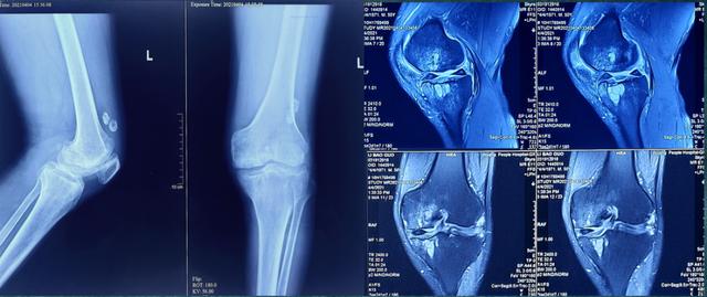 关节"大骨节病",你知道多少?